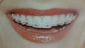 orthodontictherapy_001
