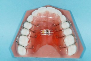 orthodontictherapy_003