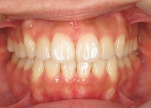orthodontictherapy_008