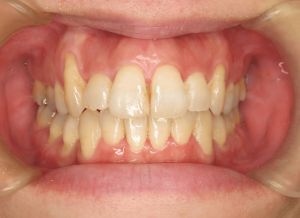 orthodontictherapy_012
