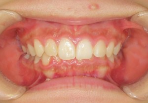orthodontictherapy_013