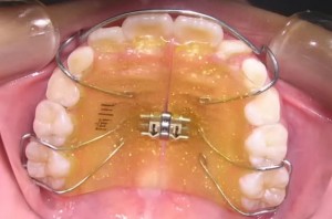 orthodontictherapy_017