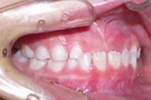 orthodontictherapy_018