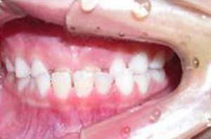 orthodontictherapy_020