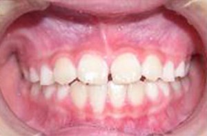 orthodontictherapy_023