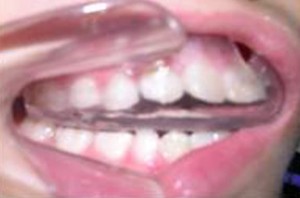 orthodontictherapy_025