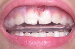 orthodontictherapy_026
