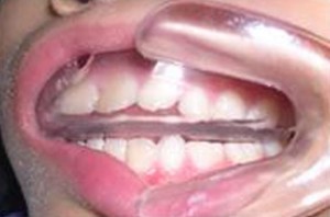 orthodontictherapy_027