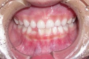 orthodontictherapy_030