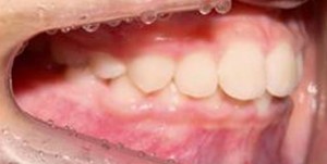 orthodontictherapy_031