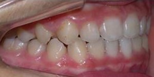 orthodontictherapy_032