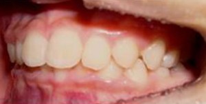 orthodontictherapy_033