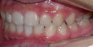 orthodontictherapy_034
