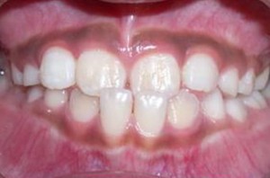 orthodontictherapy_036