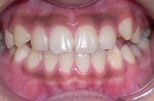 orthodontictherapy_037