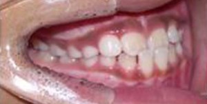 orthodontictherapy_038