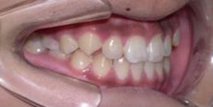 orthodontictherapy_039