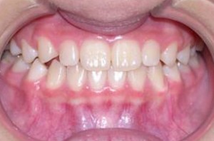 orthodontictherapy_041