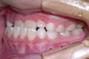 orthodontictherapy_042