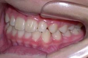 orthodontictherapy_043