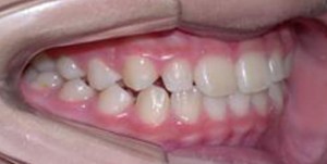 orthodontictherapy_045