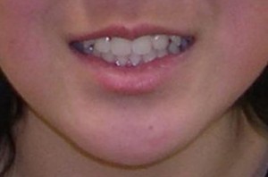 orthodontictherapy_048