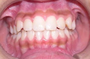 orthodontictherapy_050