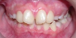 orthodontictherapy_051