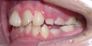 orthodontictherapy_052