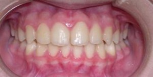 orthodontictherapy_056