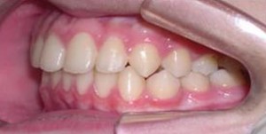 orthodontictherapy_057