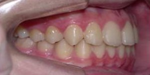 orthodontictherapy_058