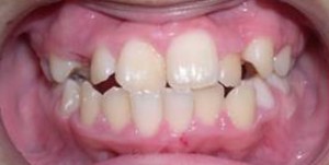 orthodontictherapy_059