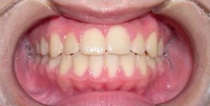 orthodontictherapy_060