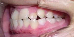 orthodontictherapy_061