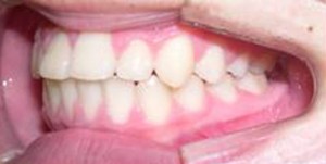 orthodontictherapy_062