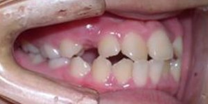 orthodontictherapy_063