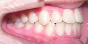 orthodontictherapy_064