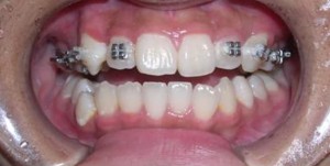 orthodontictherapy_065