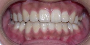 orthodontictherapy_066
