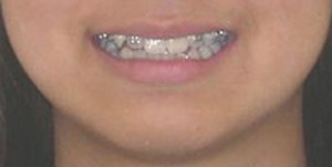 orthodontictherapy_067