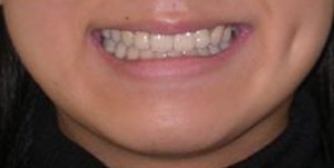 orthodontictherapy_068