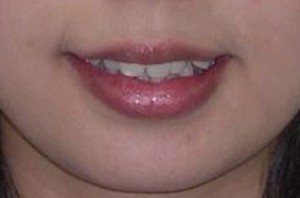 orthodontictherapy_069