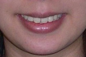 orthodontictherapy_070