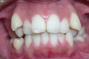 orthodontictherapy_071