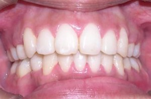 orthodontictherapy_072