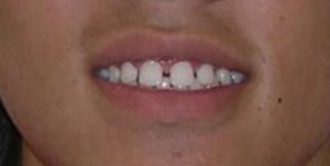 orthodontictherapy_073