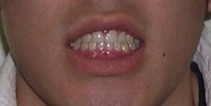 orthodontictherapy_074