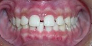 orthodontictherapy_075
