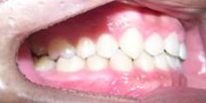 orthodontictherapy_079
